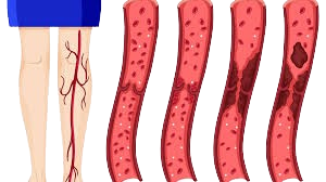 Deep Vein Thrombosis treatment & surgery cost in hyderabad