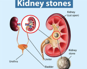 aarogyasri hospital kidney stone treatment
