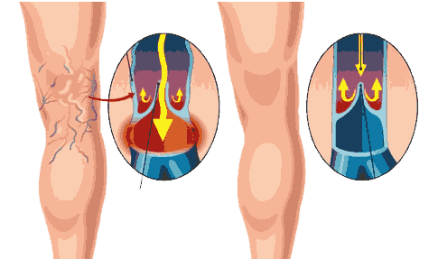 Varicose veins treatment cost in Hyderabad​