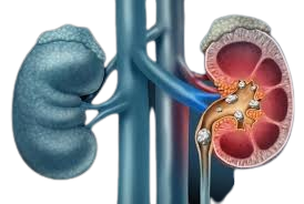kidney stone aarogyasri hospital in hyderabad