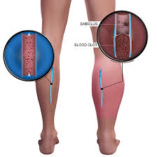 dvt surgery cost in hyderabad
