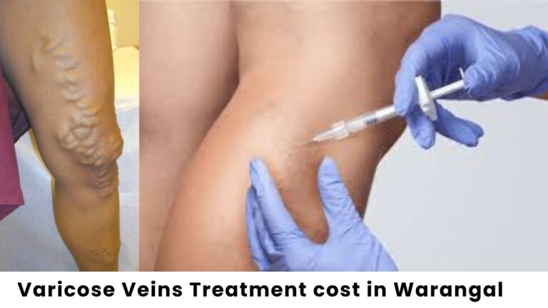 Cost Varicose Veins Treatment in Warangal​