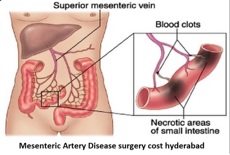 Mesenteric Artery Disease surgery cost hyderabad