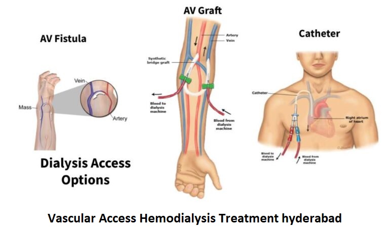 Vascular Access Hemodialysis Treatment hyderabad
