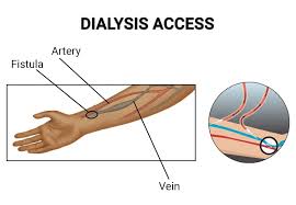 Vascular Access for Hemodialysis treatment in hyderabad