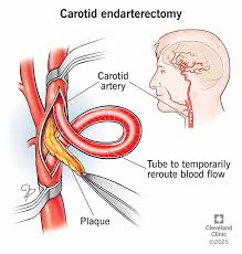 Carotid Artery Diseases surgery cost hyderabad